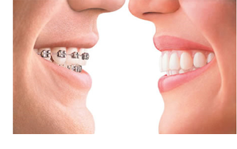 Invisalign